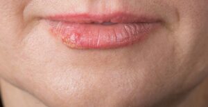 chapped lips