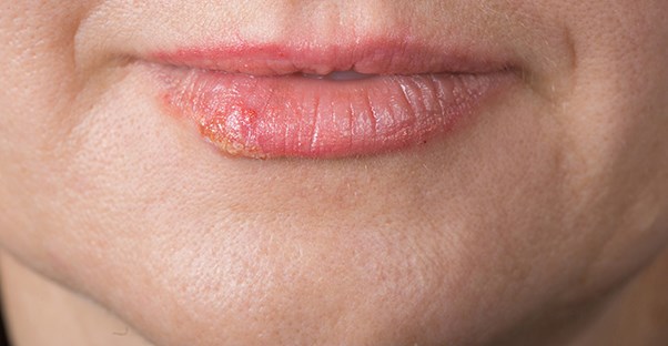 chapped lips
