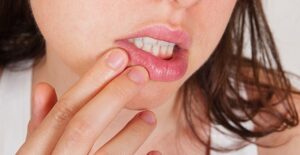girl with symptoms of chapped lips