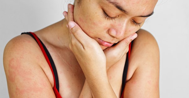 a woman feels her psoriasis symptoms on her face and neck