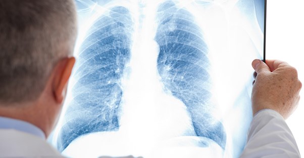 a doctor examines a chest xray to treat a pulmonary embolism