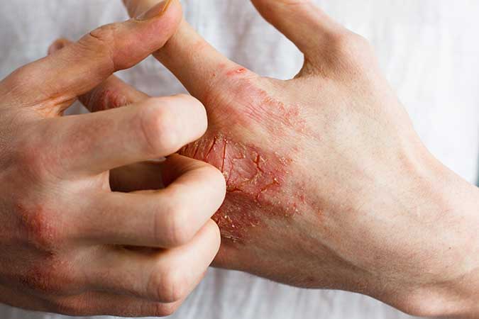 Helps Treat Eczema