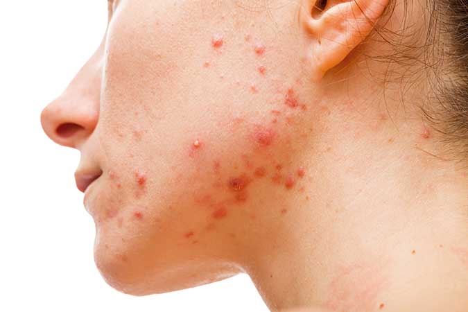 Fight Acne