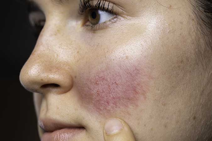 Calm Rosacea