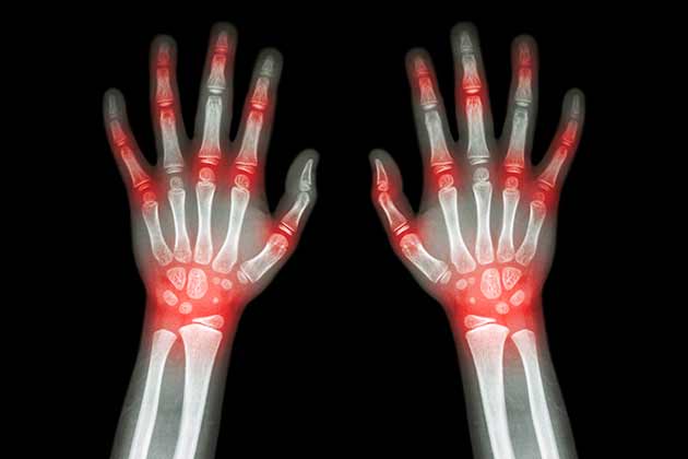 Term to Know: Inflammatory Arthritis