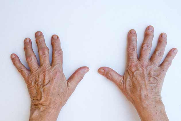 Term to Know: Tophi