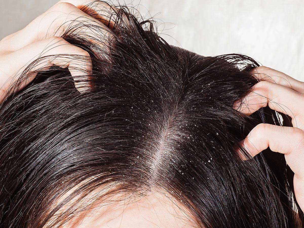 Not Caring For Your Scalp