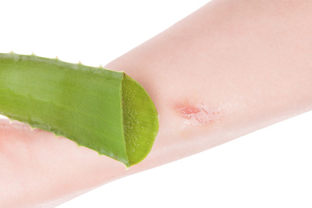 Aloe Vera for Burns