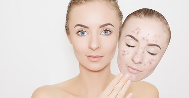Woman finding relief from her adult acne symptoms.
