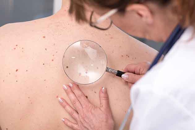 Mole Check