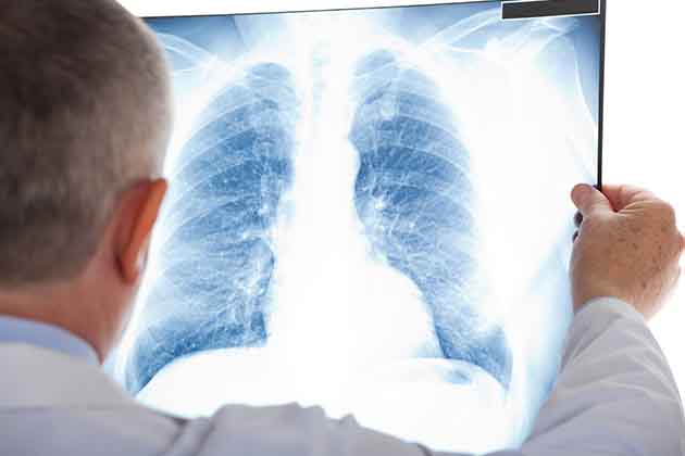 LDCT Scan