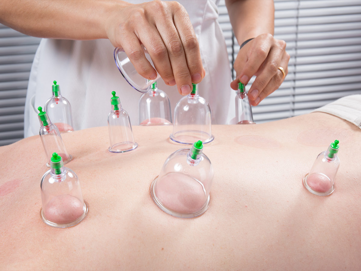 Cupping Therapy