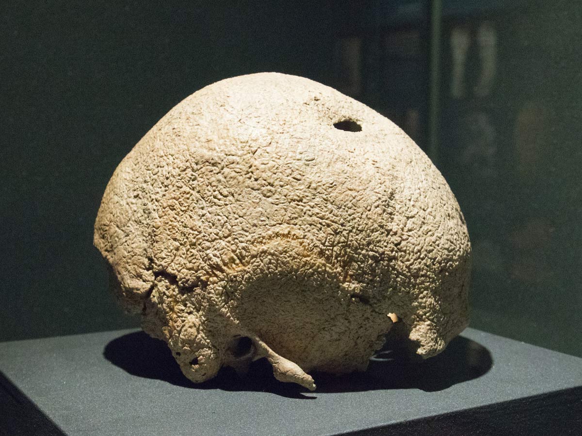 Trepanning