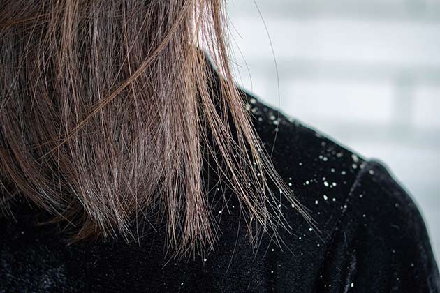Dandruff