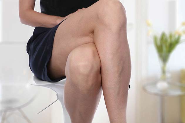 Varicose Veins