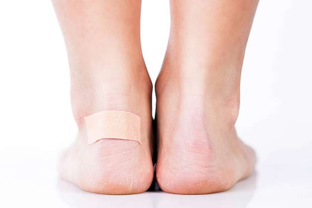 Blisters