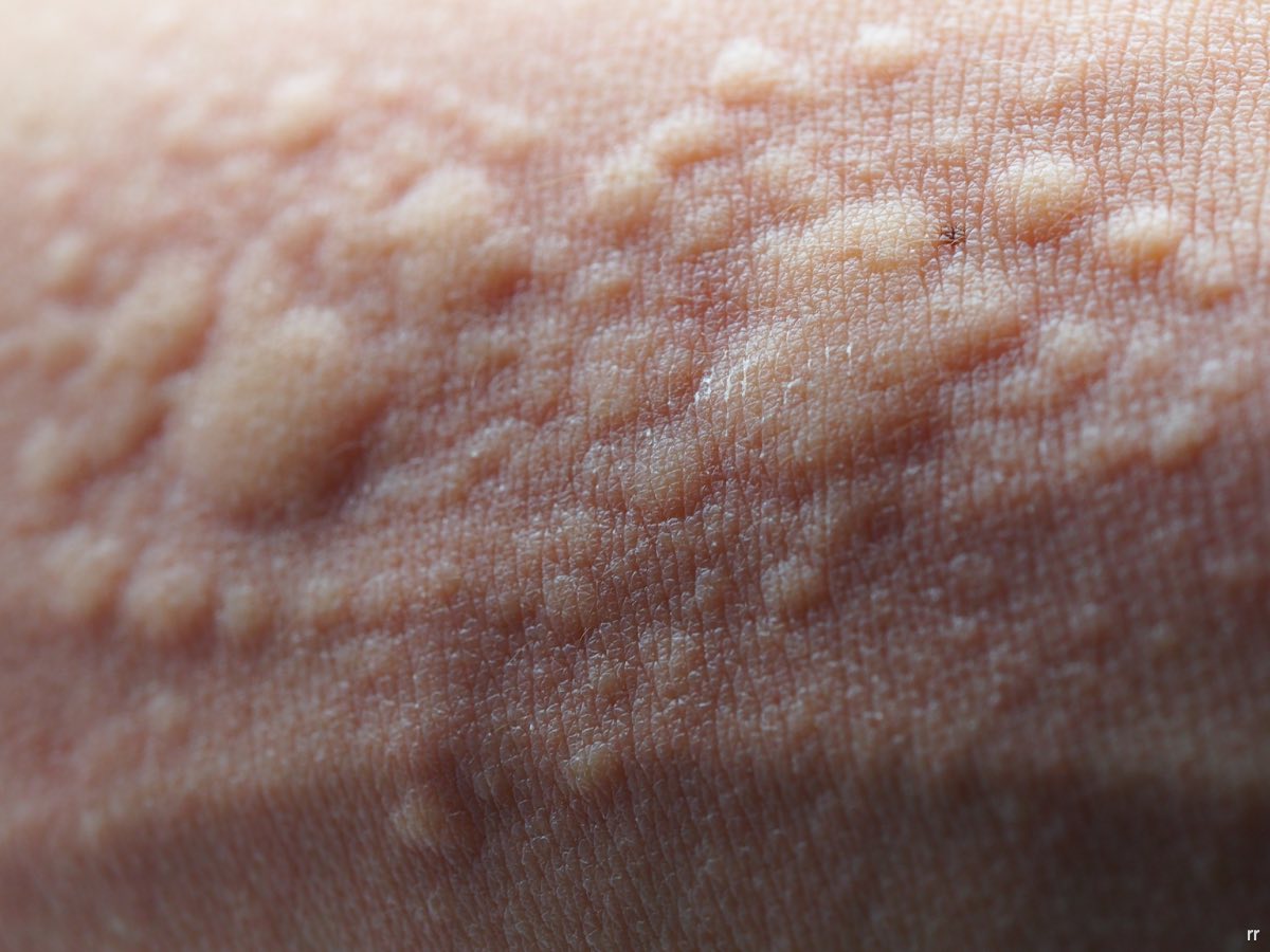 Hives
