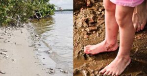 Beach diseases
