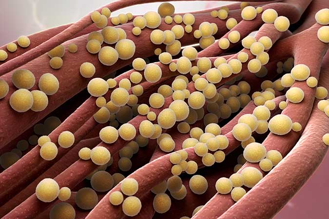 MRSA