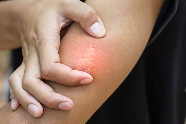 Insect Bites