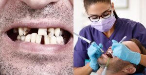 teeth cleaning