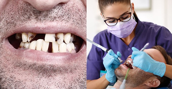 teeth cleaning