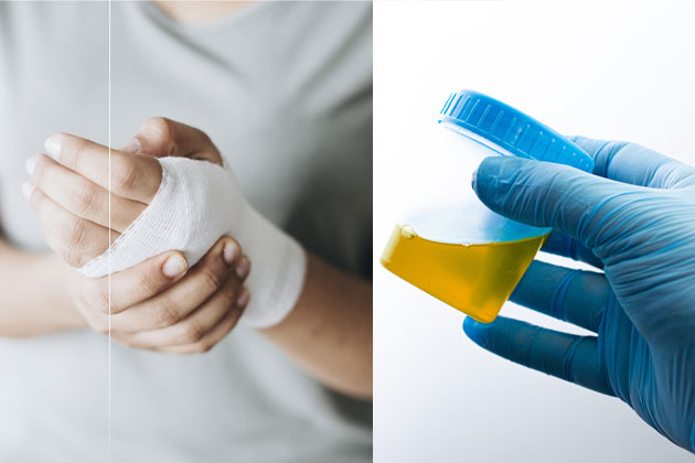 Urine for Wounds