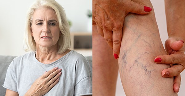 signs you have a blood clot in your leg