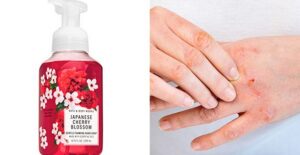 bath and body works cherry blossom soap and dermatitis