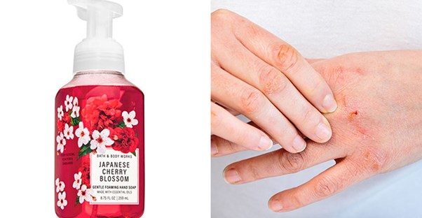 bath and body works cherry blossom soap and dermatitis