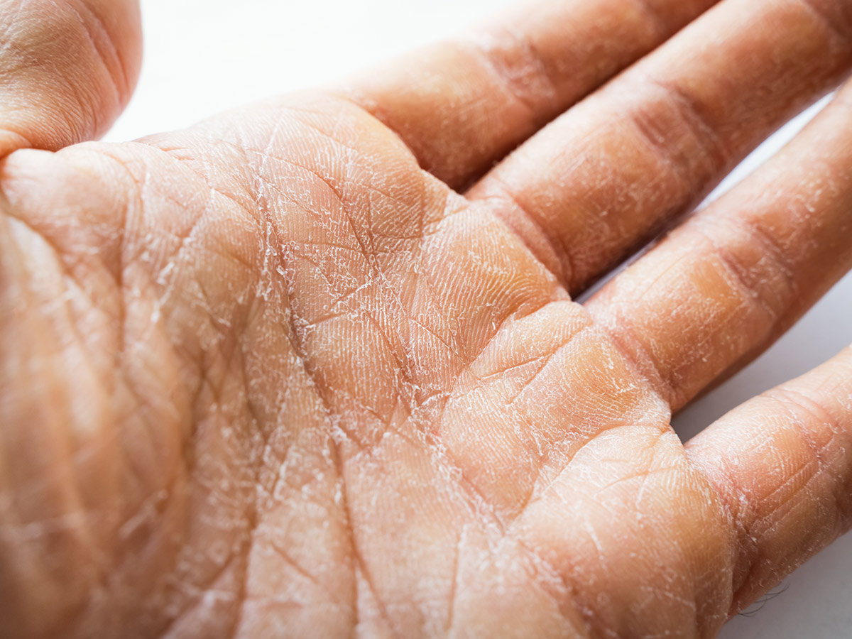 Dry Skin