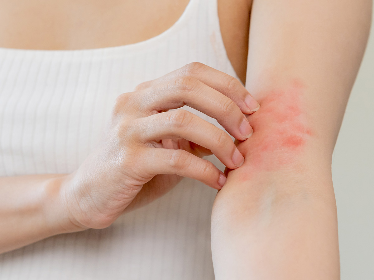 Skin Rashes