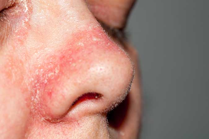 Dry Nose