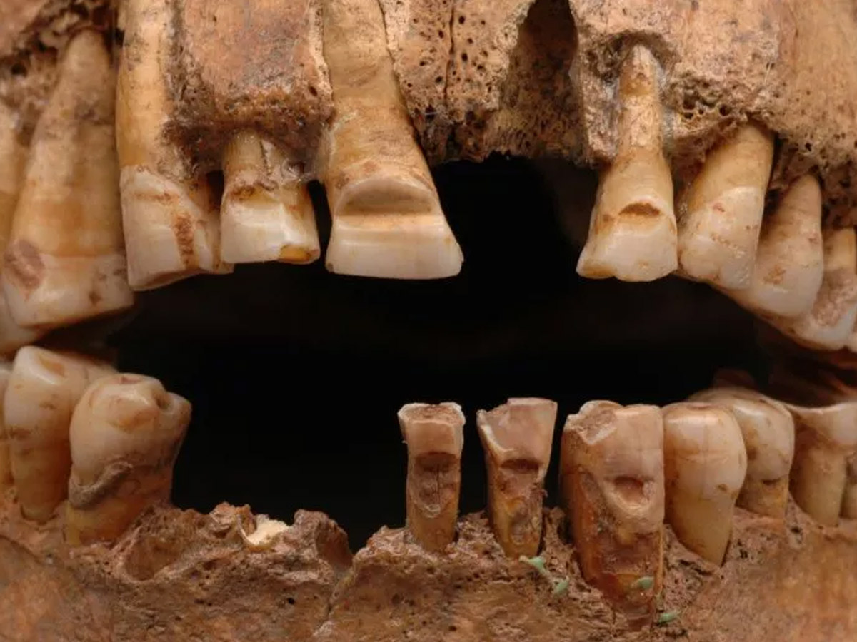 Vikings may have modified their teeth as a status symbol.