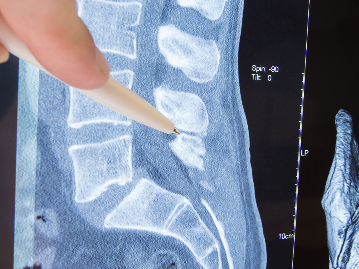 Spinal Stenosis