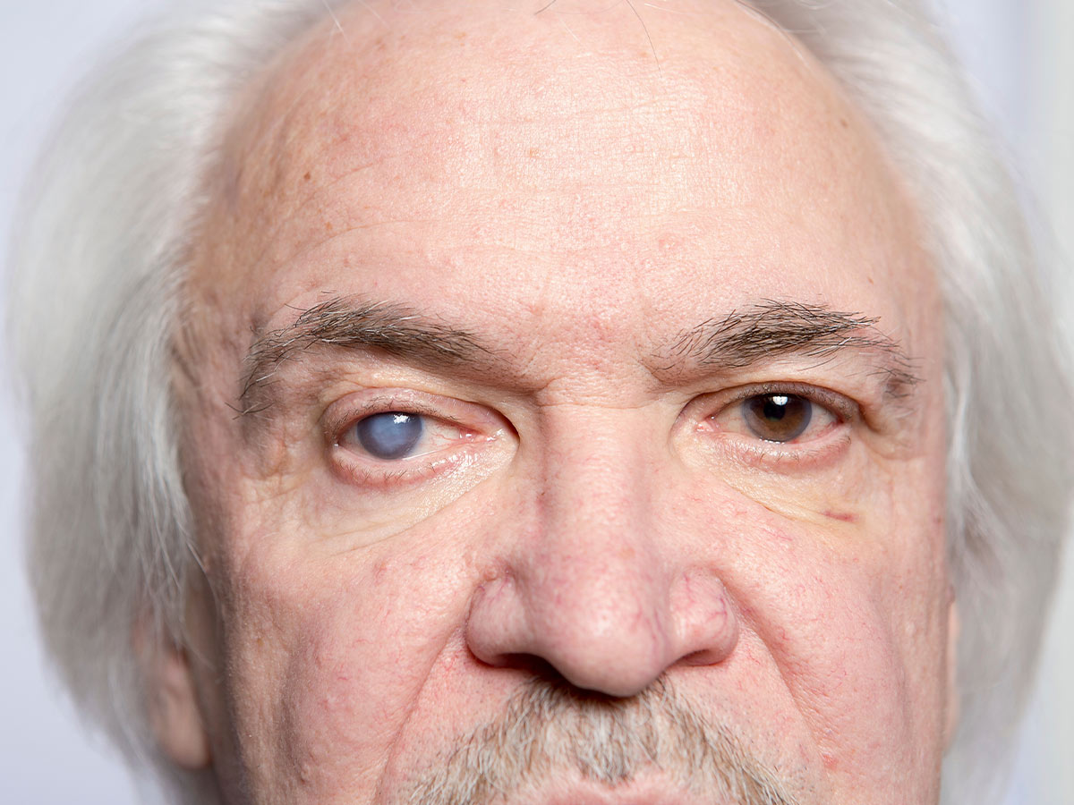 Cataracts