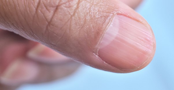 Ridges in your nails may indicate an iron deficiency