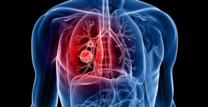 a 3D image of a lung looking for lung cancer