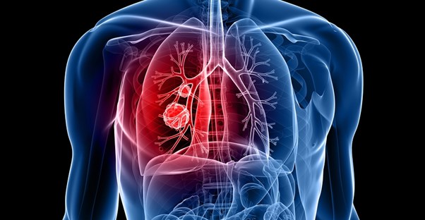 a 3D image of a lung looking for lung cancer
