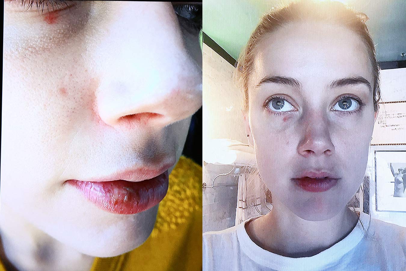 Bruises or Botox?