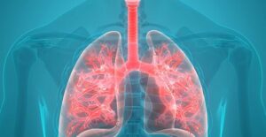 Pneumonia Signs and Symptoms