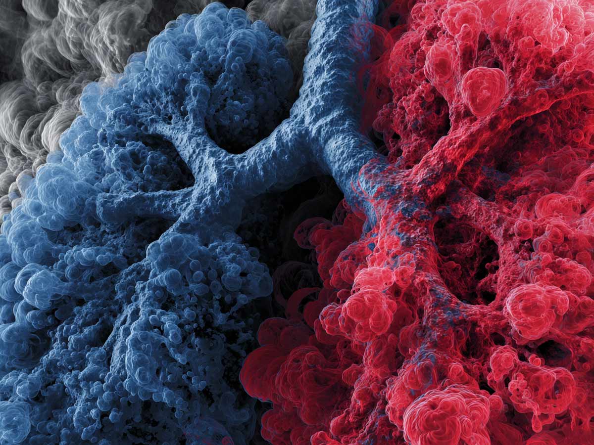 Lung Cancer