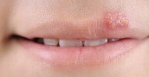 a close up of a cold sore on an upper lip