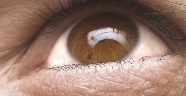 an eye diagnosed with glaucoma