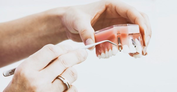 dental implants