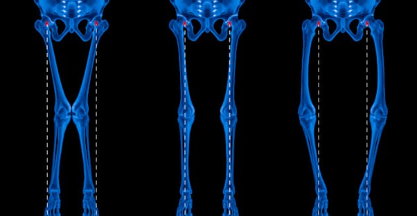 rickets disease