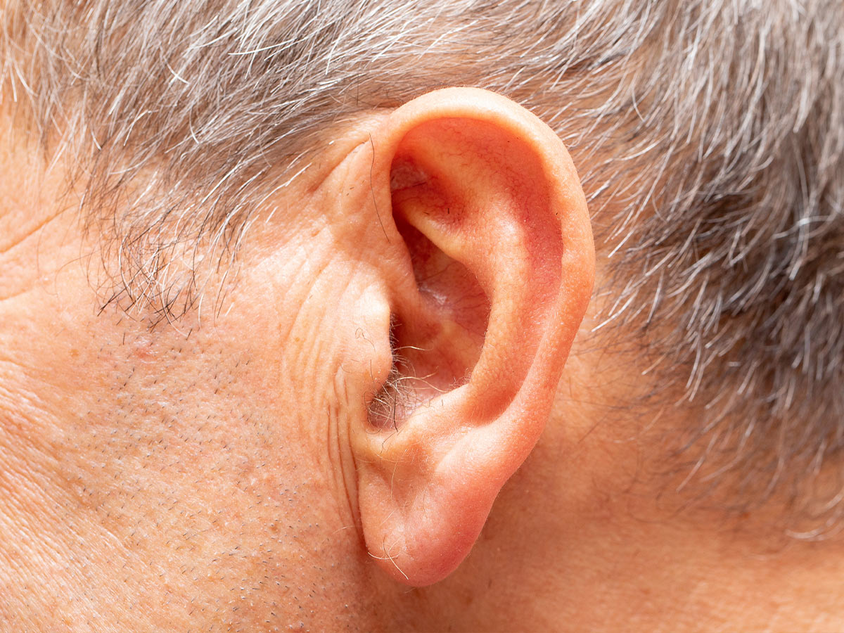Ear Lobe Crease