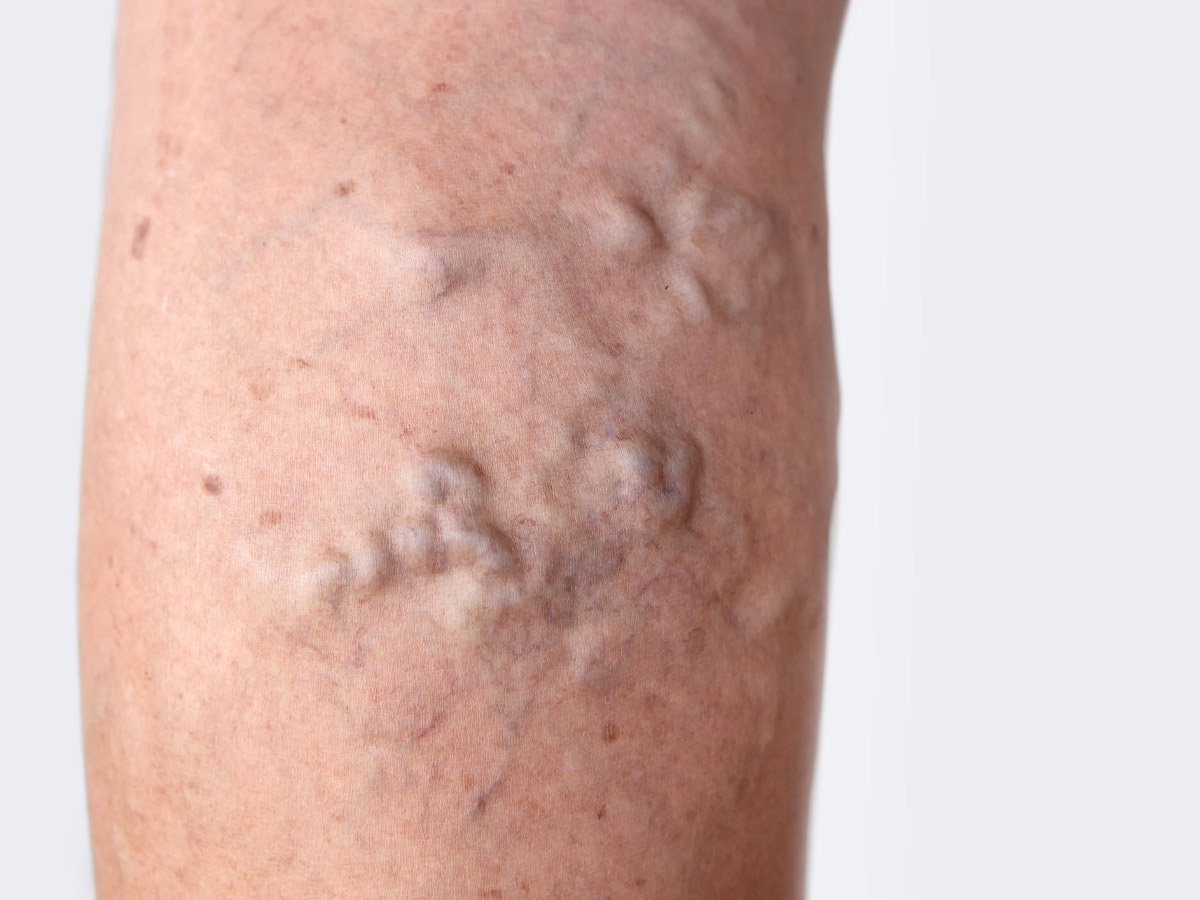 Enlarged Veins