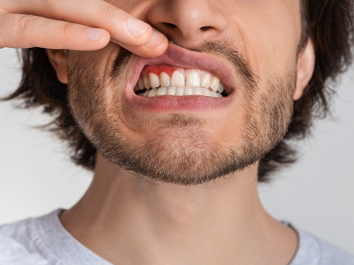 Gum Disease