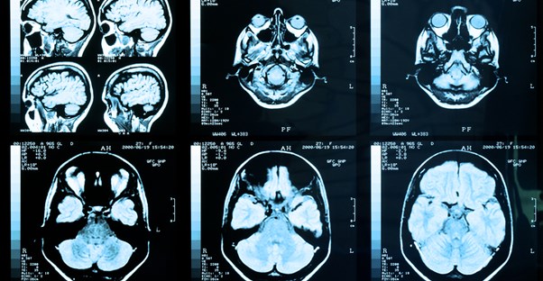a medical image depicting a brain suffering from concussion symptoms
